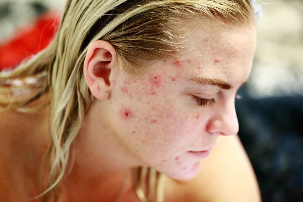 Acne Mechanica Treatment